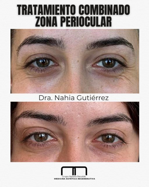 Hay miradas que lo dicen todo… pero a veces el cansancio también se nota más de lo que nos gustaría.  Para ello tenemos tratamientos personalizados, para mejorar la zona periocular.  Cuando tratamos la zona periocular de forma global, los cambios son sutiles pero muy potentes:
✔️ Ojeras más difuminadas
✔️ Párpado con aspecto más descansado
✔️ Patas de gallo suavizadas
✔️ Mirada más luminosa y fresca  No se trata de cambiar tu expresión, sino de devolverle luz a tu mirada sin perder naturalidad.  Porque a veces, un pequeño cambio lo es todo.  ¡¡Ven a vernos!!
.
.
.
#rejuvenecimientoocular #miradasqueenamoran #tratamientopersonalizado #gruponataliarecalde