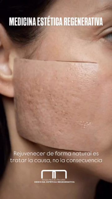 El envejecimiento facial no ocurre en una sola capa, por eso tratar solo la superficie nunca es suficiente.  Cada capa cambia con el tiempo, y cada una requiere un enfoque diferente:  •En la piel, la producción de colágeno disminuye, el grosor disminuye, la textura empeora y aparecen imperfecciones.
•En el tejido graso, los compartimentos grasos pierden volumen y migran hacia abajo, esa sensación de “hundimiento” que tanto molesta.
•En ligamentos y músculos, el soporte estructural se debilita y el contorno de la cara comienza a caer.
•En el hueso, hay reabsorción progresiva especialmente en la región malar, orbitaria y mandibular, que cambia de proporciones que ni siquiera notamos conscientemente.  Cuando planeamos un tratamiento de rejuvenecimiento,  desde la Medicina Estética Regenerativa, pensamos en todas estas capas. 
No existe un protocolo único que funcione para todos, porque cada rostro envejece de manera diferente, a ritmos distintos, con pérdidas distintas.  Por eso una evaluación individualizada marca toda la diferencia:  •El objetivo no es borrar las marcas, sino restaurar lo que se perdió: con criterio, con técnica y con respeto por la anatomía de cada persona.  Rejuvenecer de forma natural es tratar la causa, no la consecuencia.  ¡Solicita tu valoración gratuita y sin compromiso!
.
.
.
#mediconaesteticaregenerativa #bellezanatural😍 #tratamientopersonalizado #gruponataliarecalde